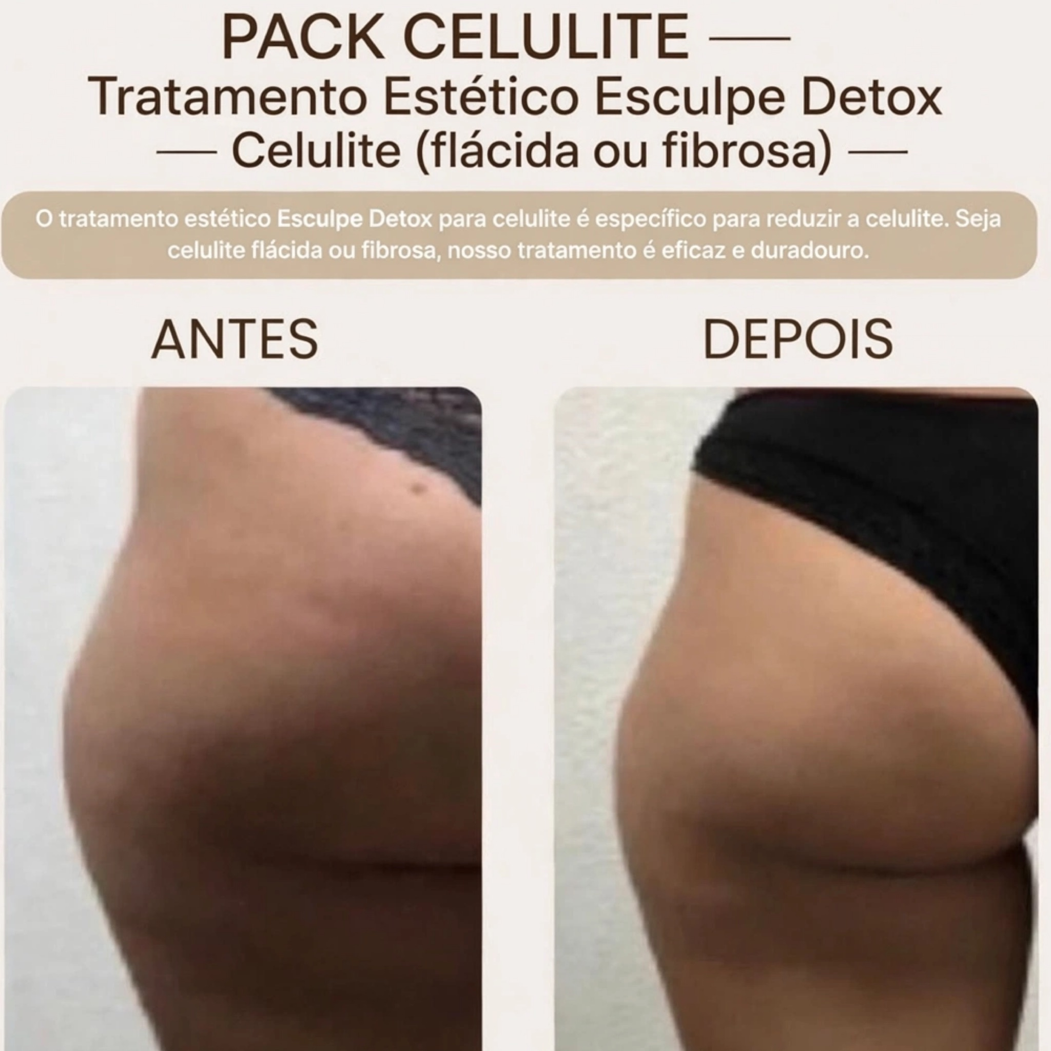 ✨ CELULITE- TRATAMENTO ESTÉTICO ESCULPE DETOX (45min)