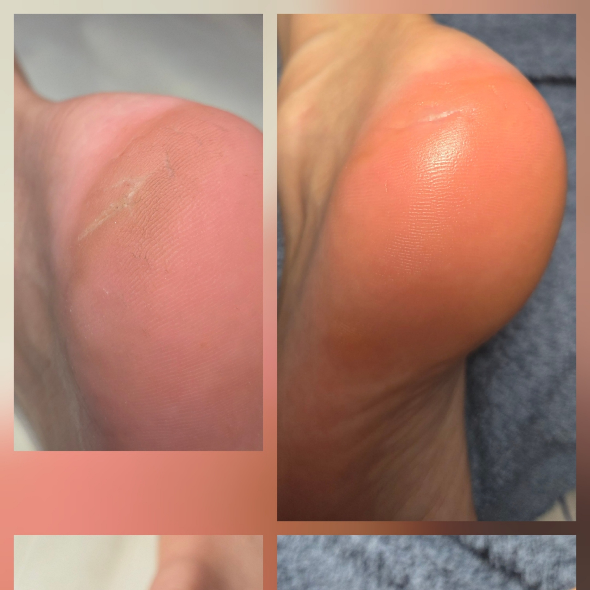 Soin des callosités Yumi feet