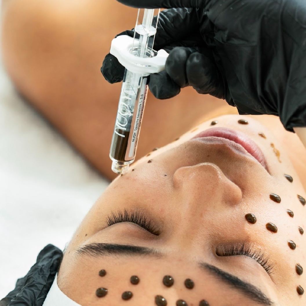 Bio-mikrojehličkování (FCR peeling)