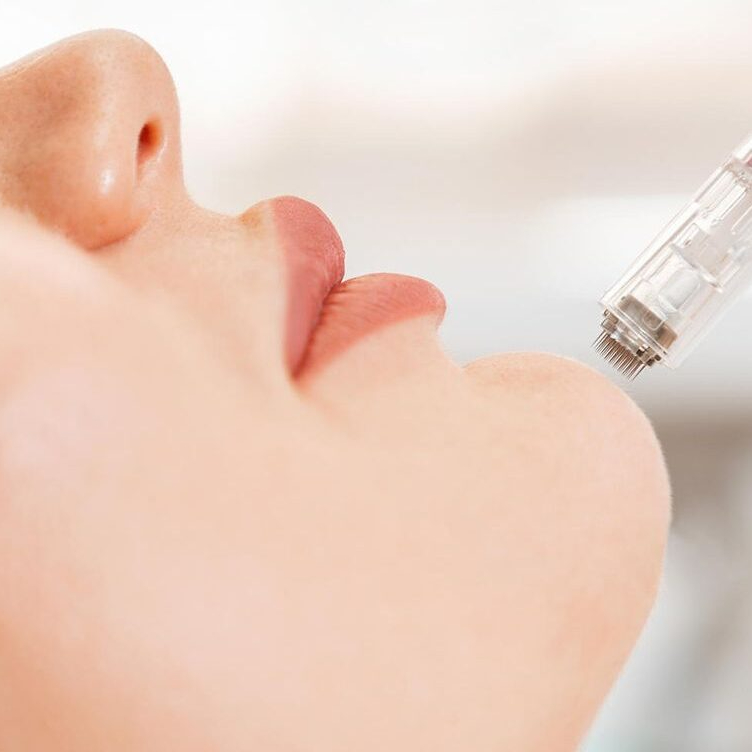 Microneedling Gesicht, Hals und Dekolleté