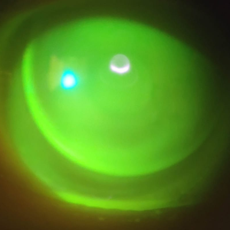 Adaptación de Lentes de Contacto