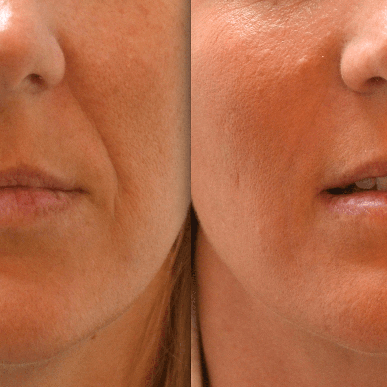 Lifting Coréen visage complet + cou