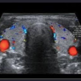 Colordoppler ultrasound of thyroid