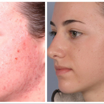 Ošetření problematické/aknozní pleti