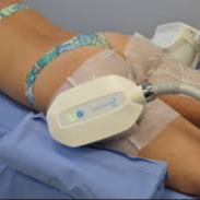 Criolipolisi Culotte de Cheval