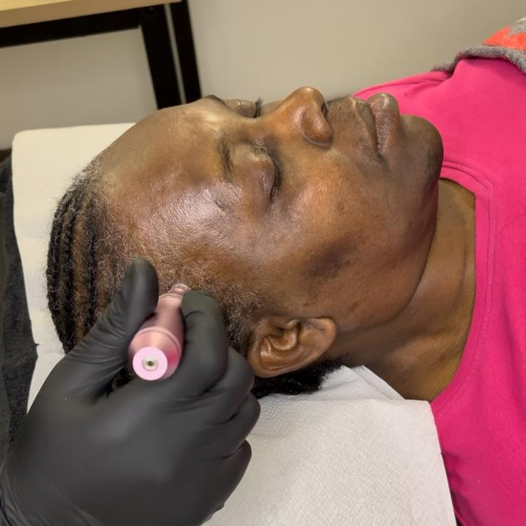 Hairneedling - Tempes ou zones localisées - forfait 4 séances