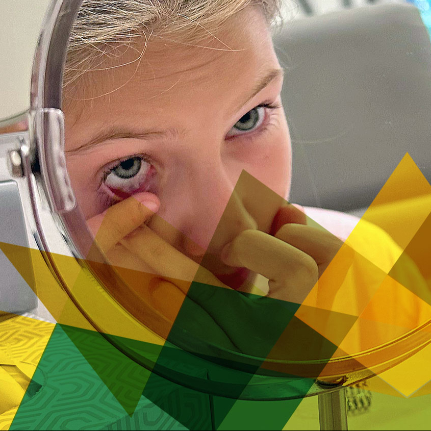 Aplikace kontaktních čoček (i pro děti)