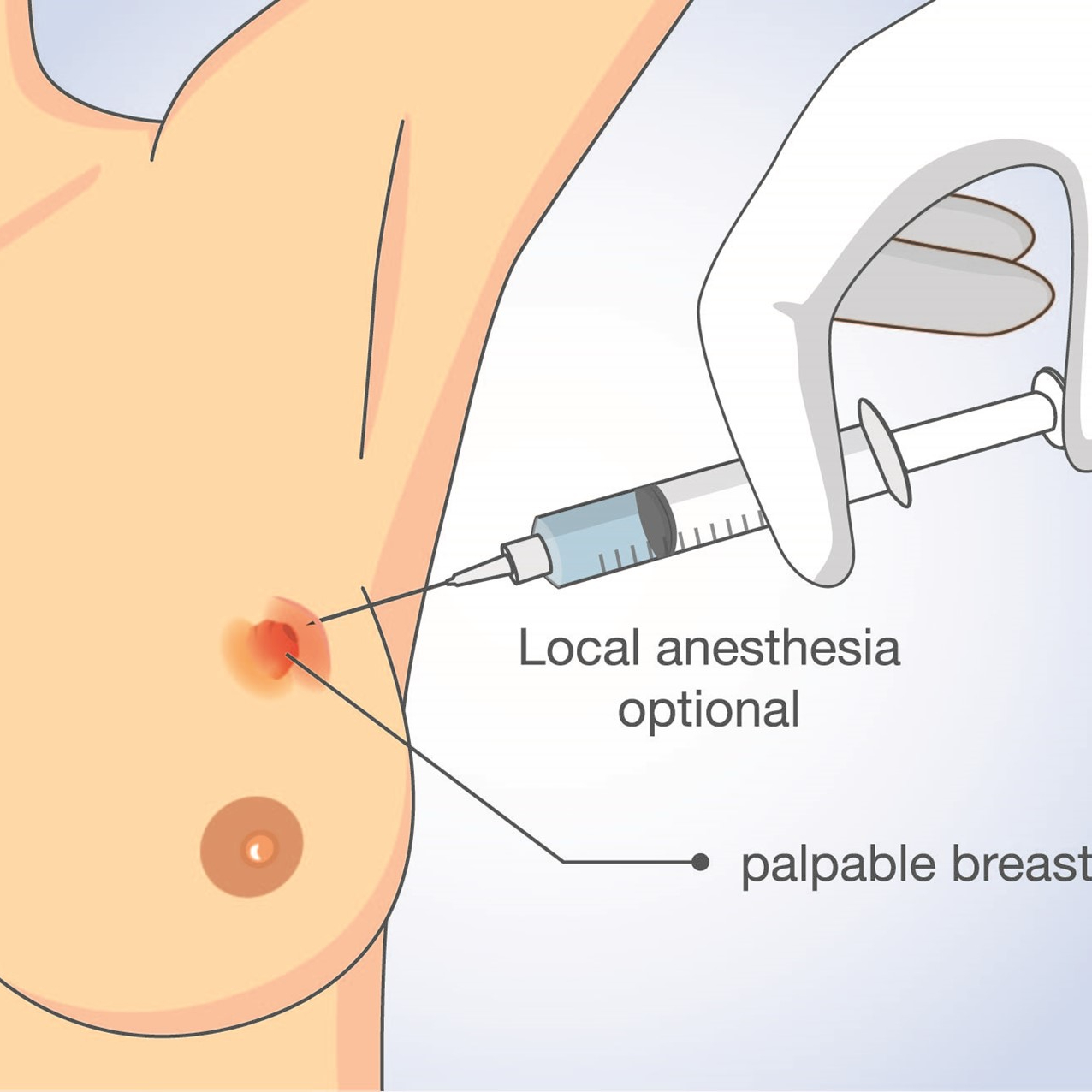 Biopsia con aguja Gruesa (BAG)