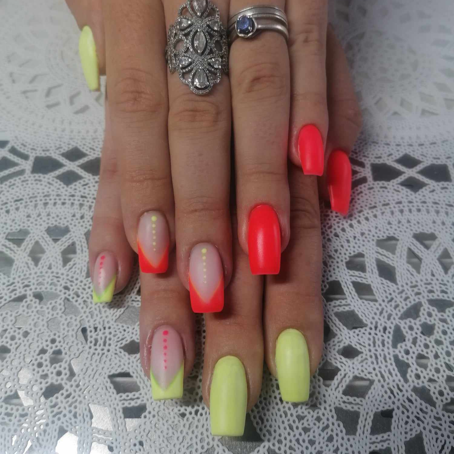 dépose partielle autre prothésiste + remplissage