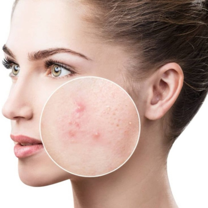 Mazoregulačné ošetrenie (Akné) Mesoceuticalab Sebo-rego