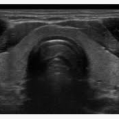 Thyroid ultrasound