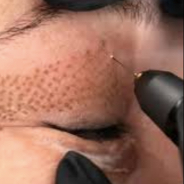 Plasma pen - horní víčka