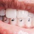 4 strass dentaire dent du bas