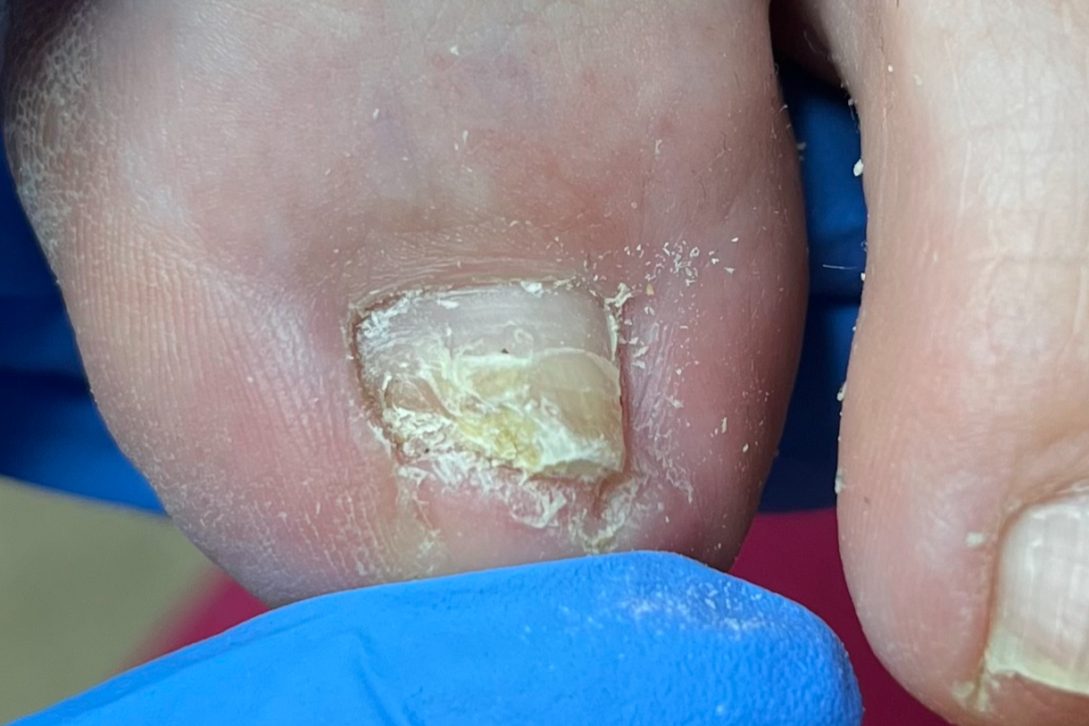 Ošetření poškozených nehtů