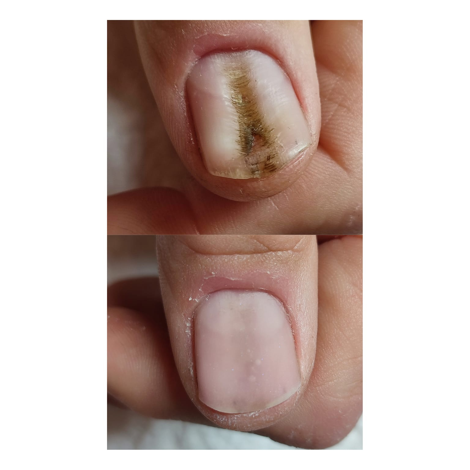 Reconstitution d'ongle