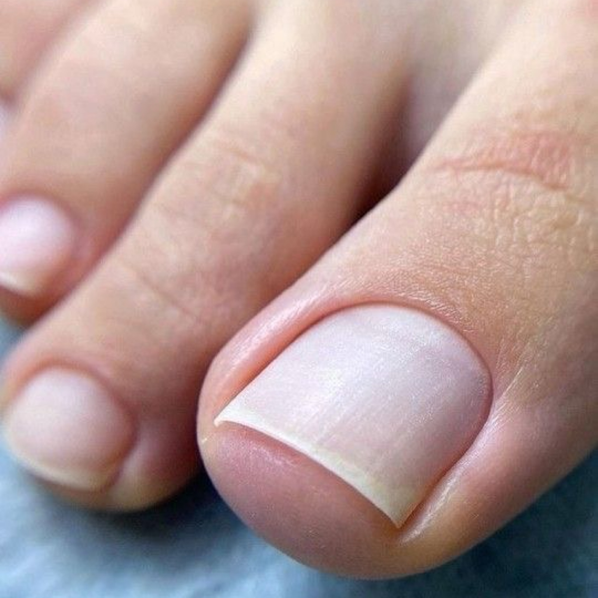 Dépose gel