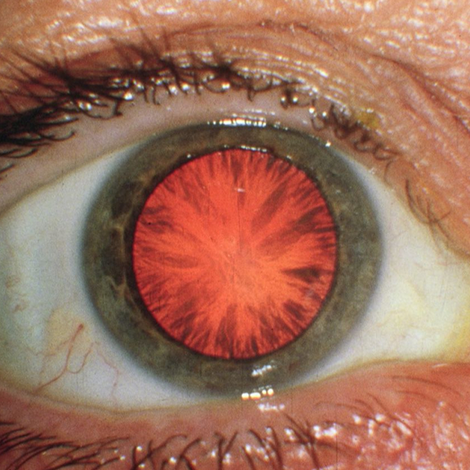 Cataract Assessment