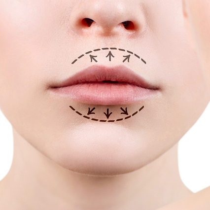 filler labbra