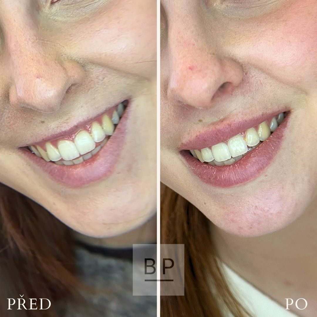 Aplikace botulotoxinu - 1 malá oblast (lip flip, DAO..)