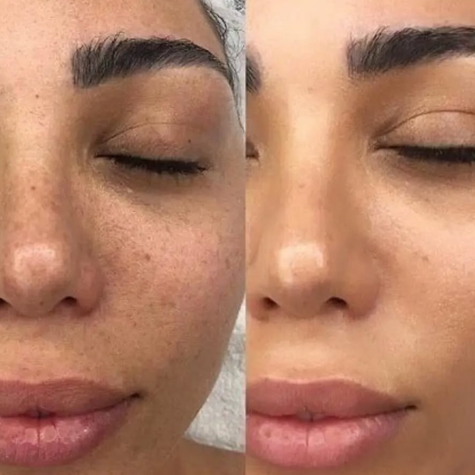 Mezoterapie s kyselinou hyaluronovu, peptidy - menší partie