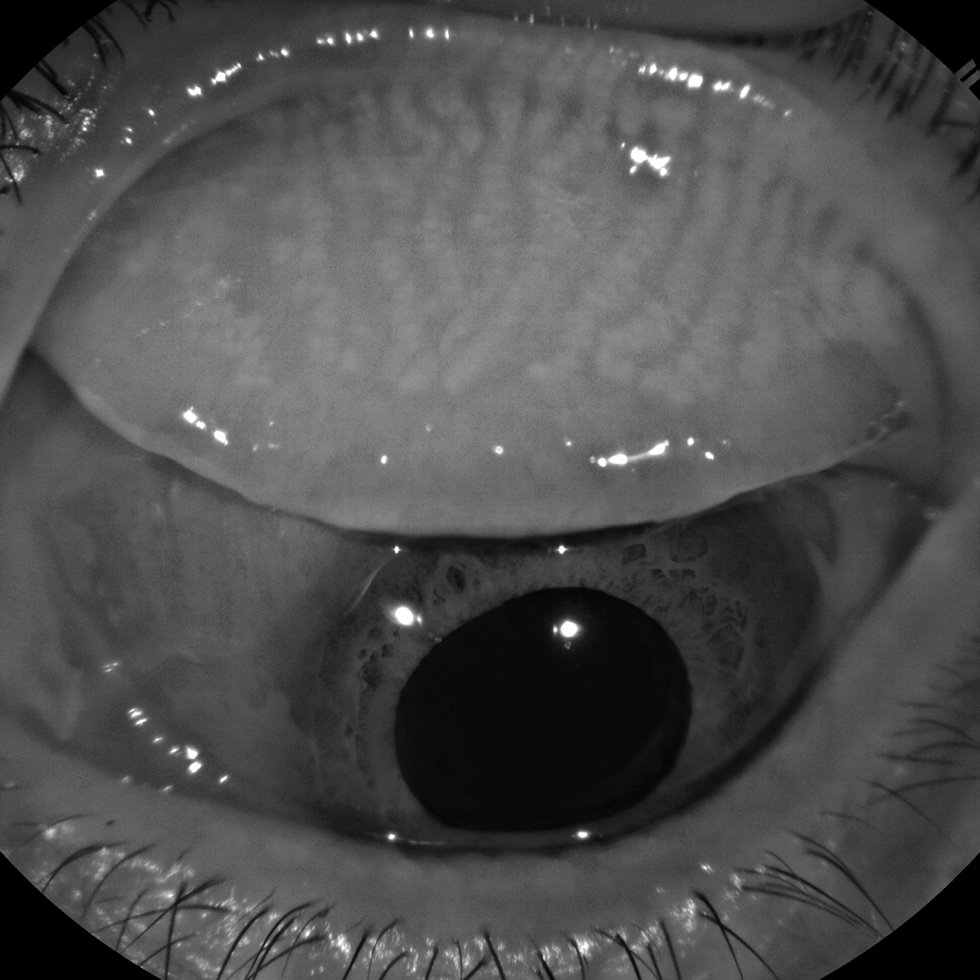 Dry Eye Assessment