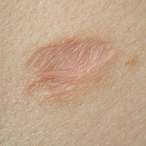 ošetření jizev - jejich integrace do okolní tkáně