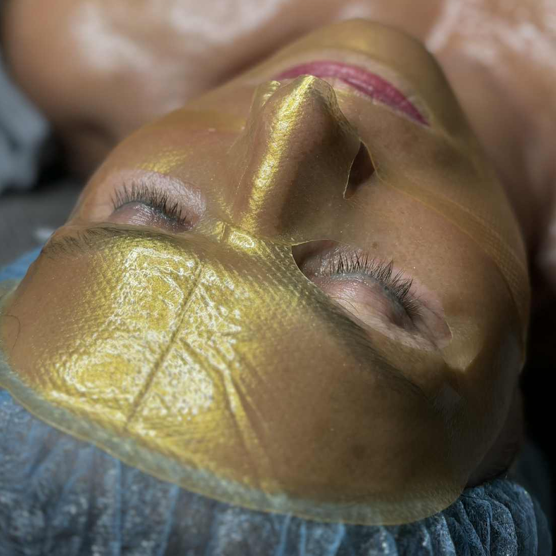 Výplň vrásek kys.hyaluronovou