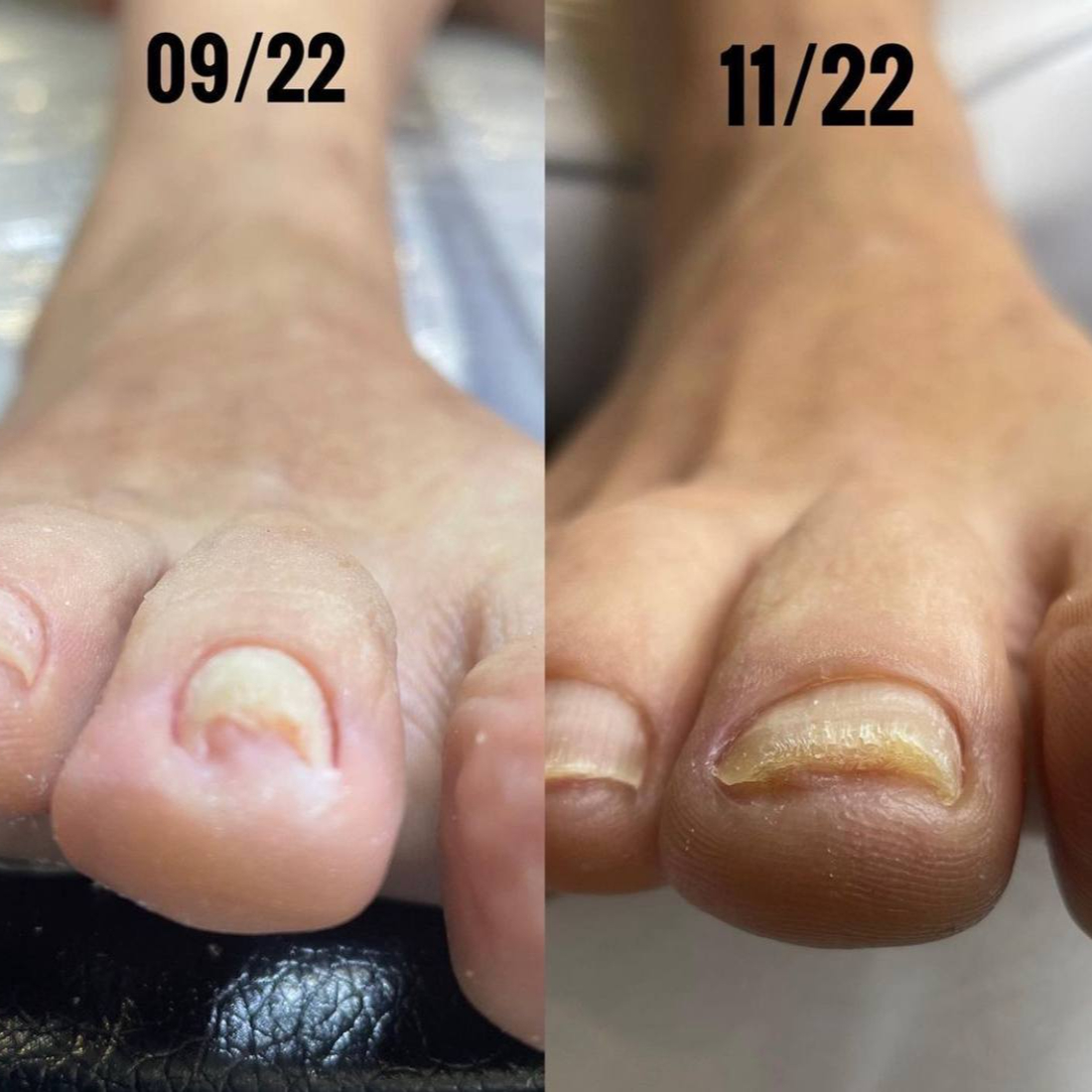 Titanová nehtová špona ( 1 nehet a 1. úprava)