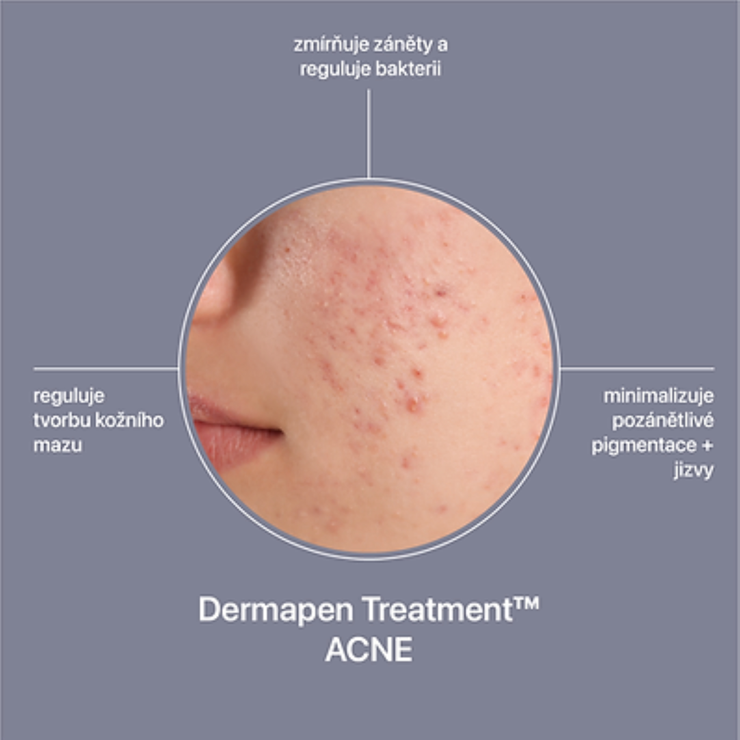 Dermapen Treatment™ Acne