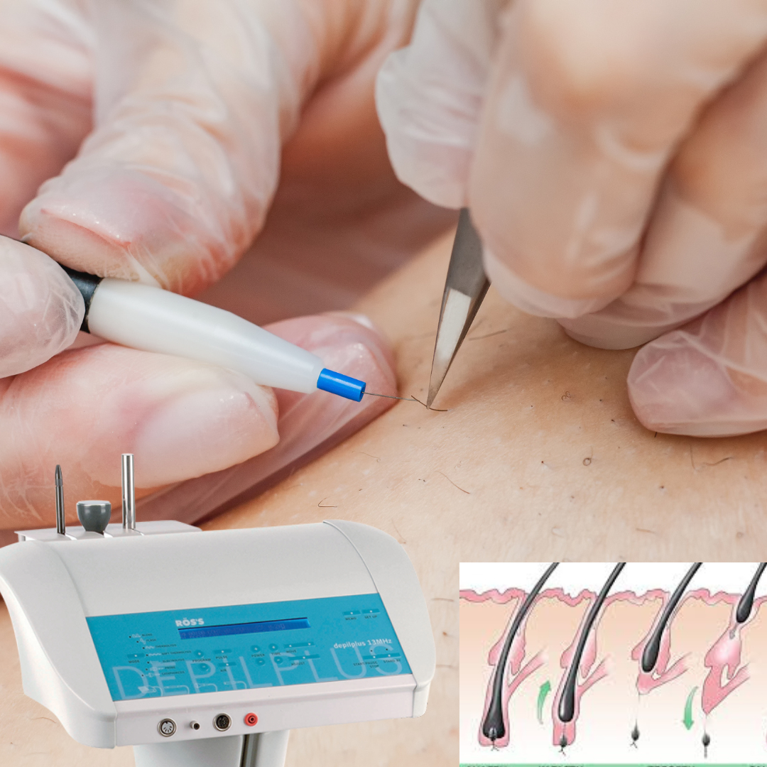 Specialist Elektroepilace / Electrolysis