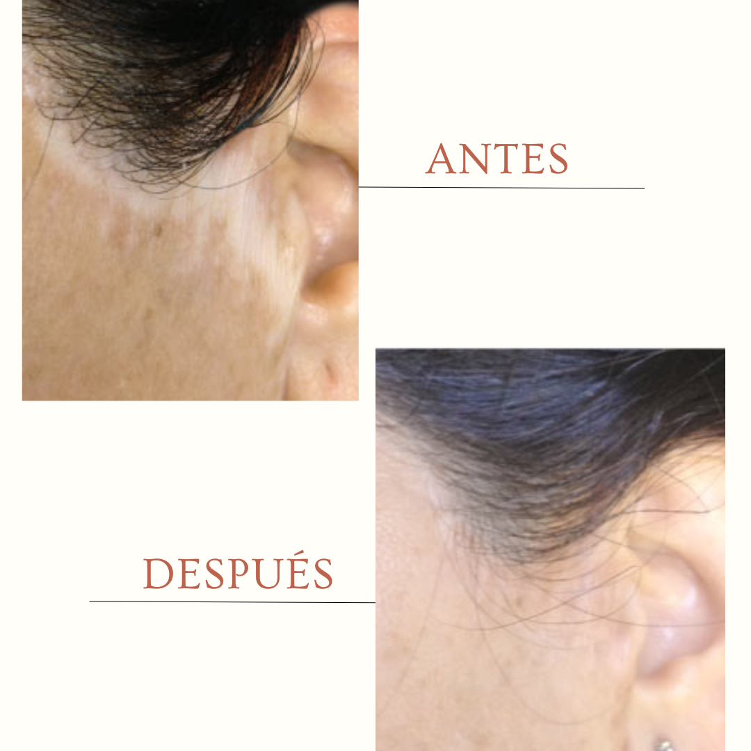 Cicatrices pequeñas