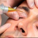 BLEFAROPLASTIA NÃO CIRURGICA COM JATO DE PLASMA