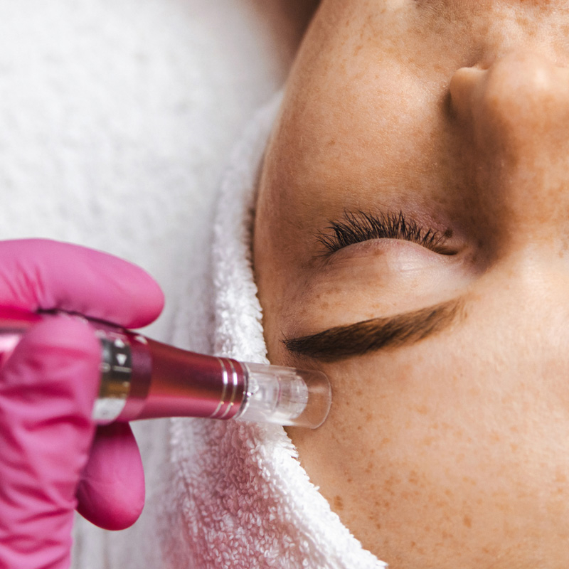 Dermapen con electroporación