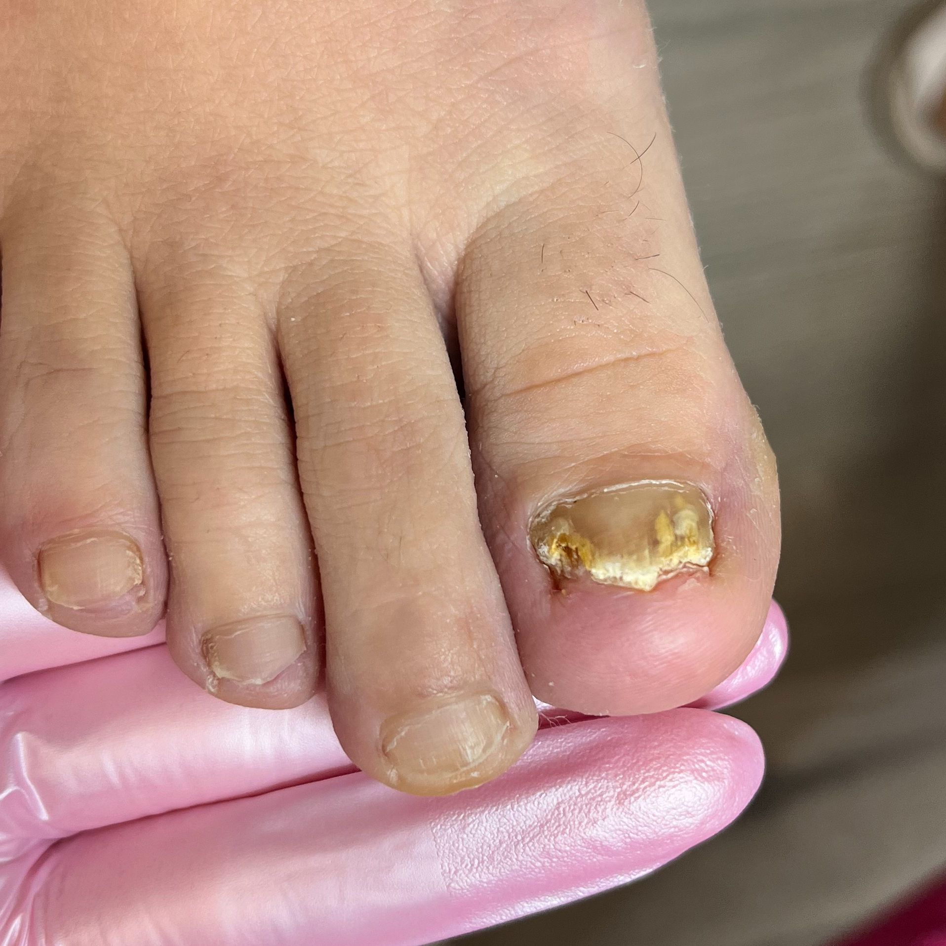 Podologická pedikúra (s podezřením na plíseň / psoriázu)