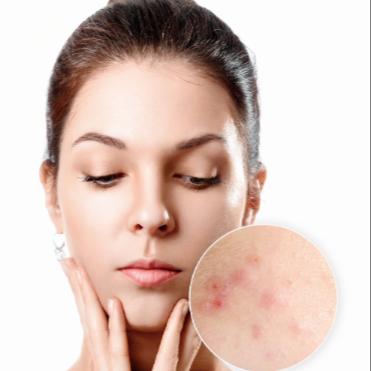 IPL  léčba akné, jizvy, červené žilky - obličej