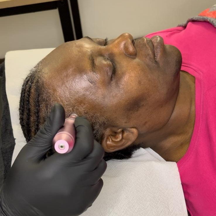 Hairneedling - Tempes ou zones localisées - forfait 6 séances