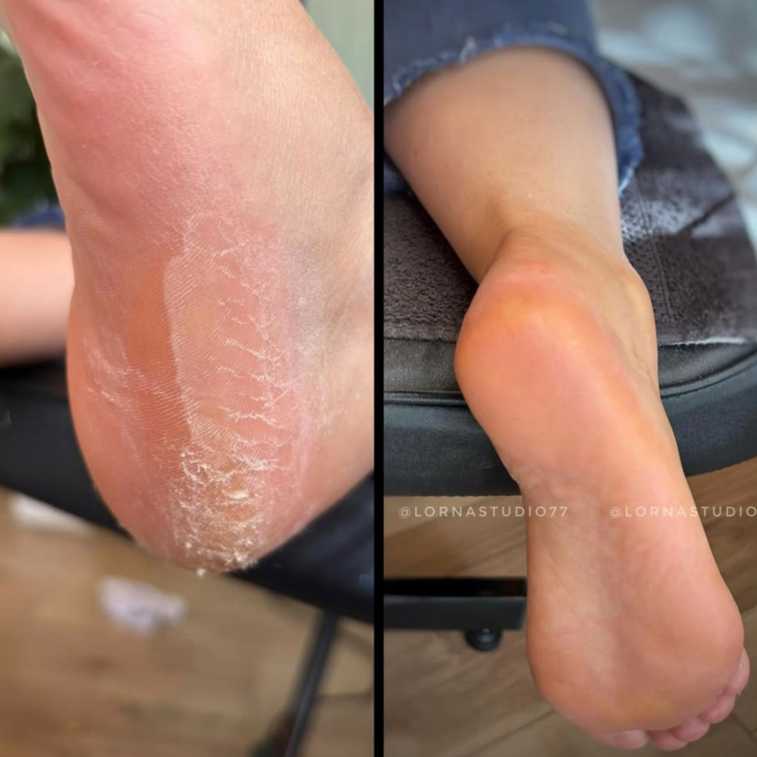 Soin anti-callosités