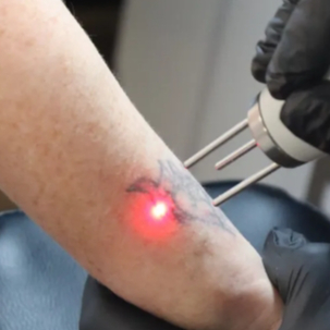 Tatoeagepuntjes verwijderen na kanker (GRATIS)