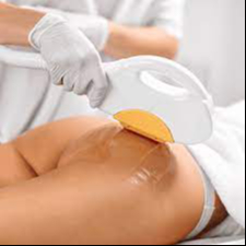 Depilação Laser SHR Glúteos