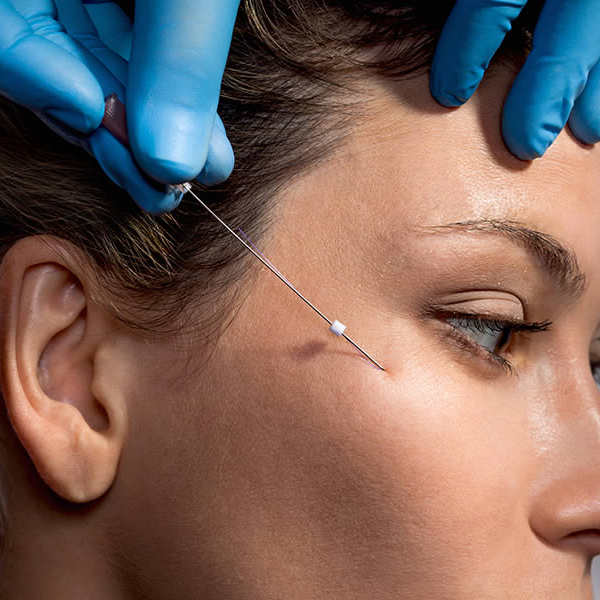 Lifting non chirurgico con fili pdo