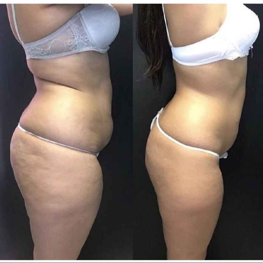 Jednorázové ošetření - zábal VACUSLIM 48