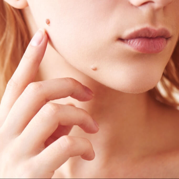 Vyšetření znamének digitálním dermatoskopem