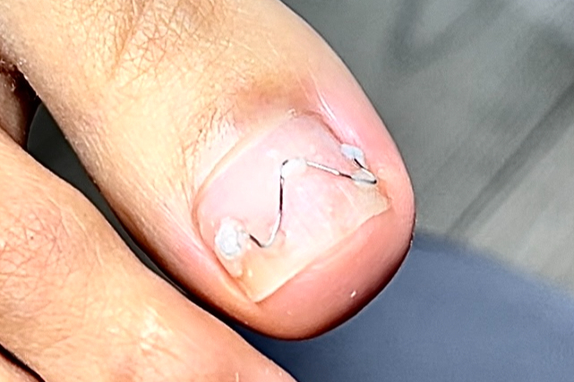 Rovnaní zarostlých nehtů