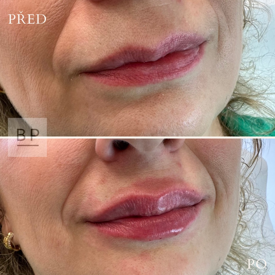 Augmentace rtů - juicy lips  (aplikace 0,7 ml)