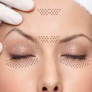 Plasma lifting hele gezicht