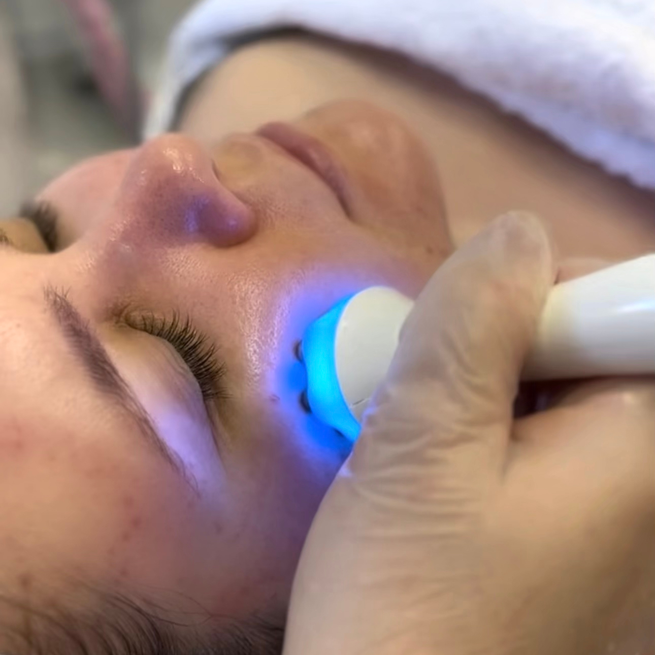 MEZOPORÁCIA – hĺbková výživa pleti, mezoterapia bez ihiel