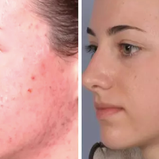 Ošetření problematické/aknozní pleti