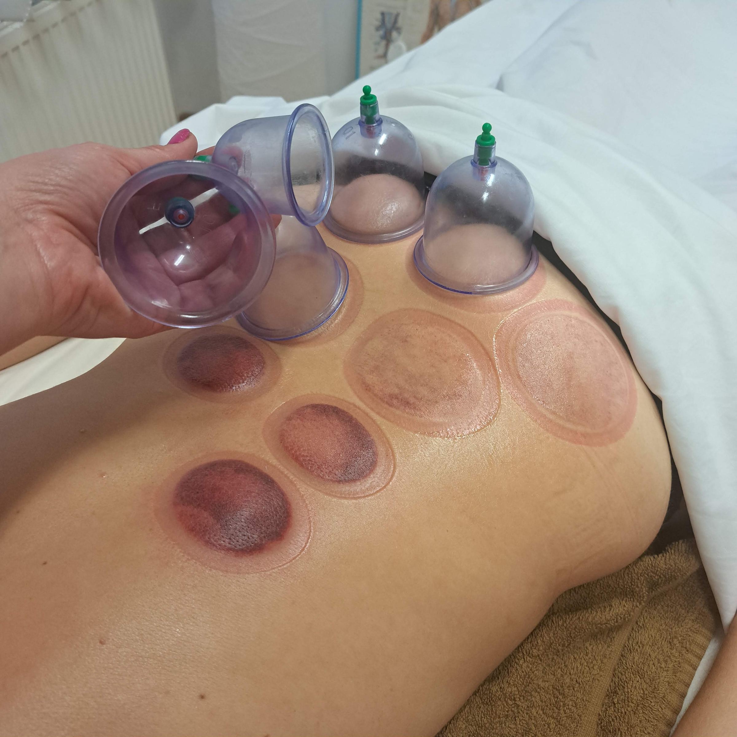 Rehabilitace/Zdravotní masáže/Baňkování -  60min