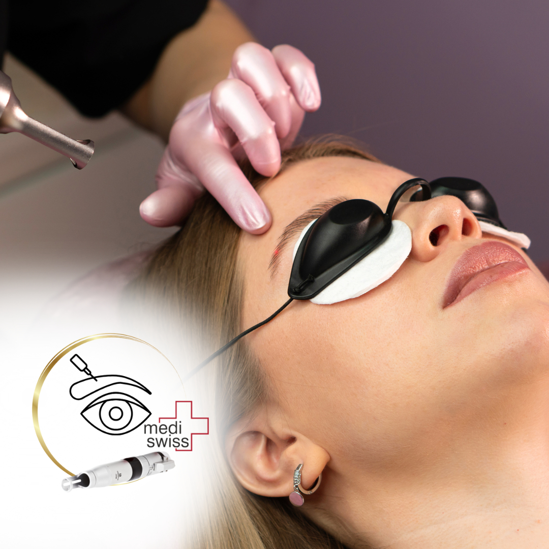 ODSTRANĚNÍ PMU Laserem - (obočí)