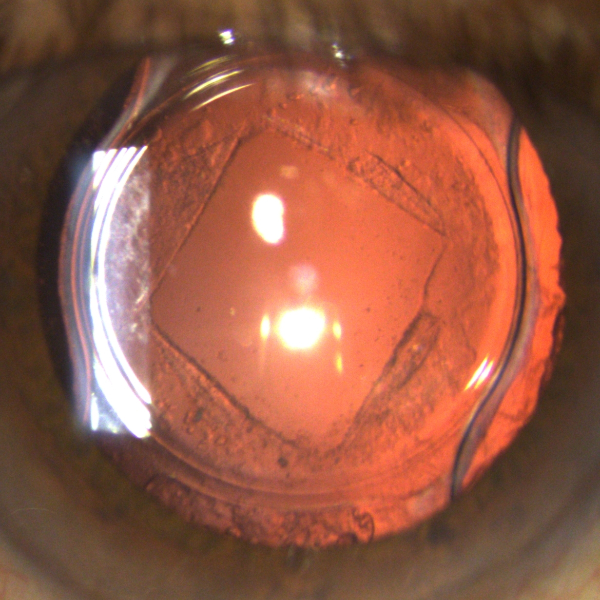 YAG Laser at The Eye Clinic